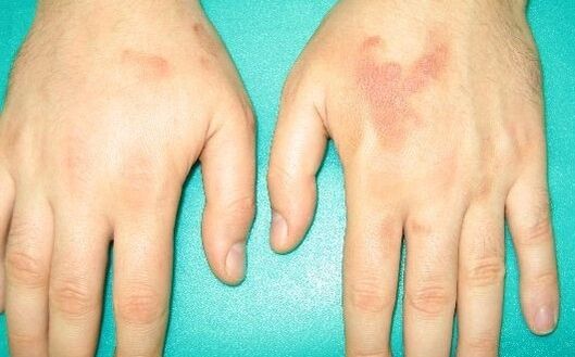 bolest v kloubech rukou může být příznaky parazitů