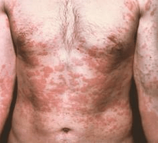 problematická pleť je příznakem přítomnosti parazitů