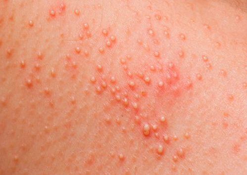 Pokud je tělo napadeno parazity, objeví se kožní alergie