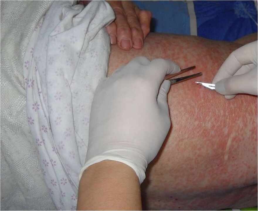 Škrábání postižené oblasti k detekci parazitů pod kůží